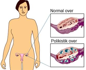 Sindromul Ovarelor Polichistice (SOP)