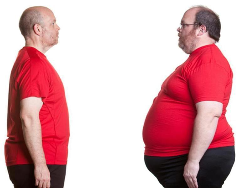 Obezitatea Morbidă: Riscuri pentru Sănătate și Opțiuni de Tratament