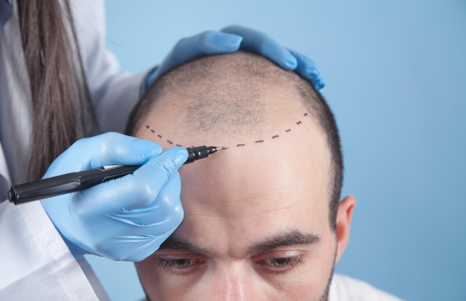 Hair Transplantation in Fue Method